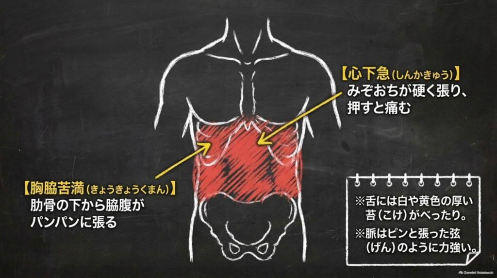 胸脇苦満（肋骨の下から脇腹がパンパンに張る）と心下急（みぞおちが硬く張り押すと痛む）
